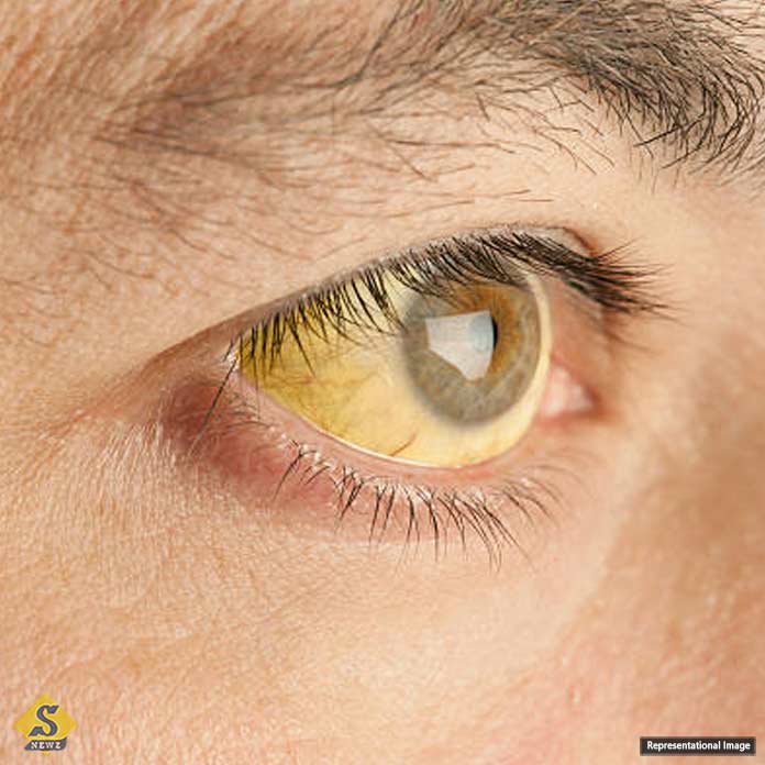 Jaundice increases in summer