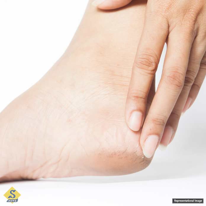Cracked feet in winter