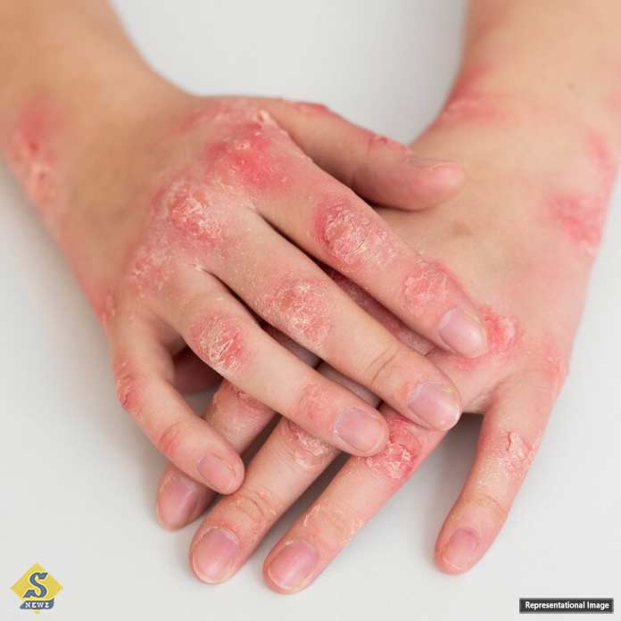 skin-disease