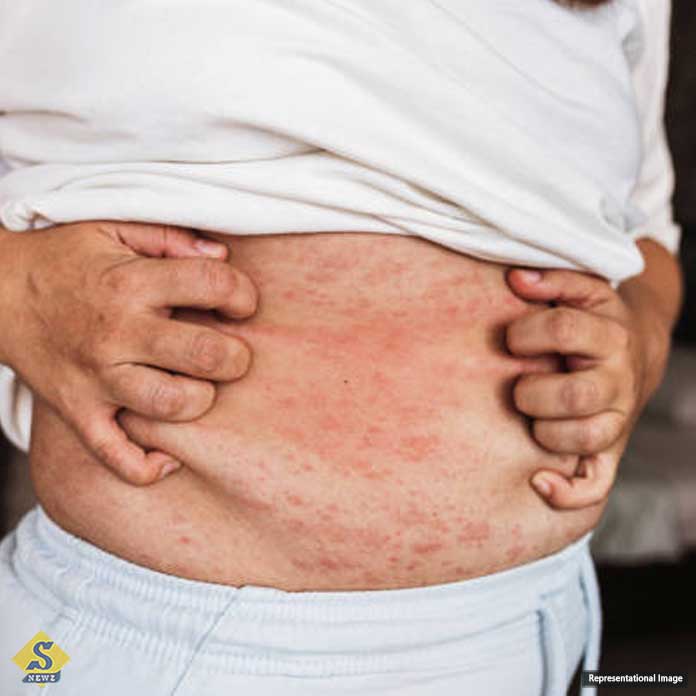 Psoriasis_-Which-oil-is-less-painful