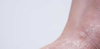 ব্লাড সুগার থাকলে পায়ে ইনফেকশন