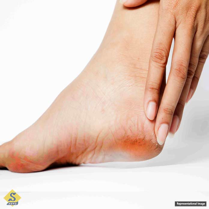 How-to-get-rid-of-cracked-heels-in-summer