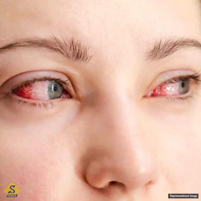 Eye-pressure-is-increasing