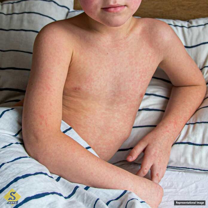 Rash-all-over-the-child's-body
