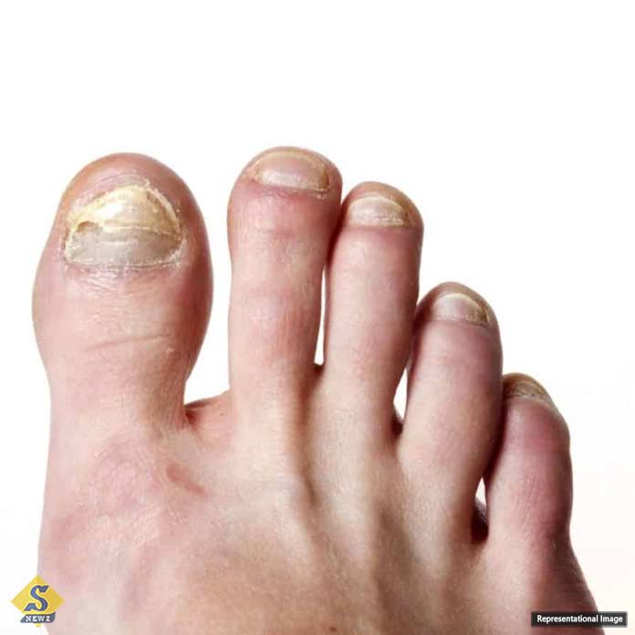 Nails-crack-due-to-vitamin-deficiency
