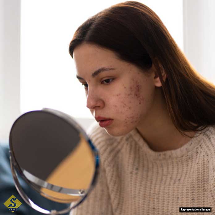 Acne-on-the-face-despite-skin-care