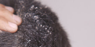 খুশকির সমস্যা কেন হয়?