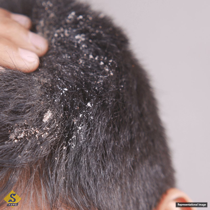 Why-is-dandruff-a-problem