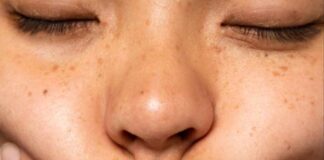 ঠোঁটের চারপাশের কালচে দাগ