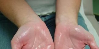 হাইপারহাইড্রোসিস : লক্ষণ ও কারণ